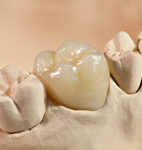Porcelain crowns prior to placement