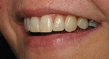 Closeup of patient's smile after six month smiles