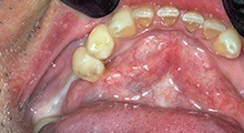 Teeth after tooth colored fillings are placed