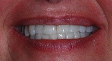 Closeup of Laura's smile after Invisalign