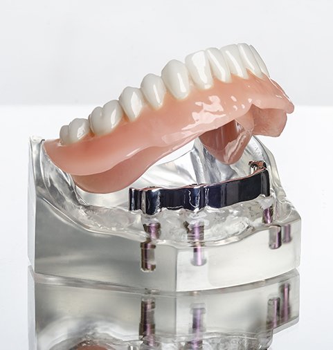 Implant denture illustration