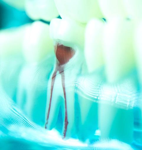 an image showing an infected tooth