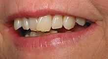 Closeup of patient's smile before six month smiles