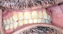 Closeup of Gary's smile after Invisalign