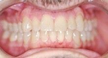 Closeup of Gary's smile before Invisalign