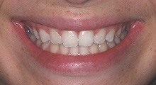 Closeup of Raven's smile after Invisalign