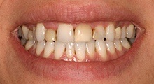 Closeup of Cindy's smile before treatment