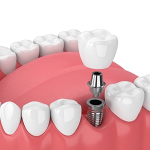 single dental implant supporting a crown 
