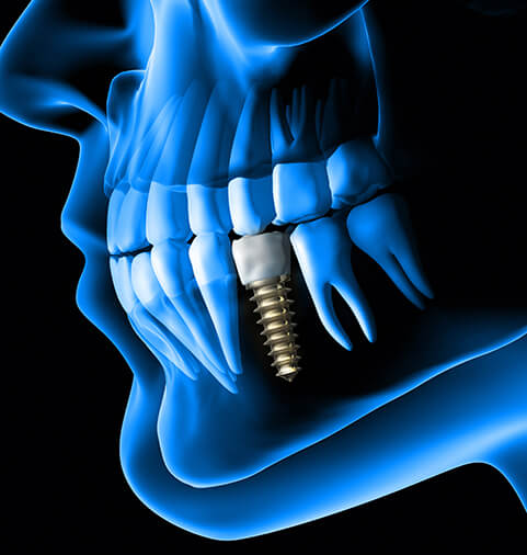 Diagram of X-ray of dental implants in Merrimack