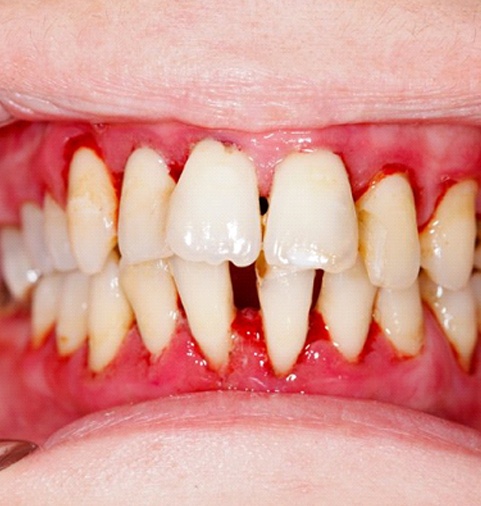 A closeup of a mouth with periodontitis.