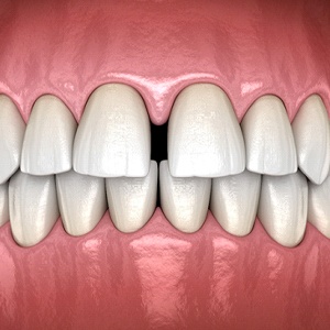 Gap between front teeth before SureSmile in Marrimack